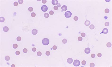 Anisocytosis – Cells and Smears