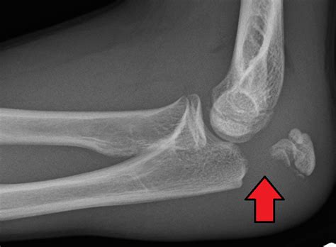 Olecranon fracture - Wikiwand