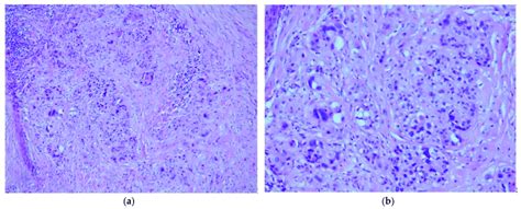 Histopathological Exam Of The Sample Hematoxylin And Eosin Hande A