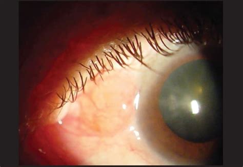 Conjunctival Lymphoma