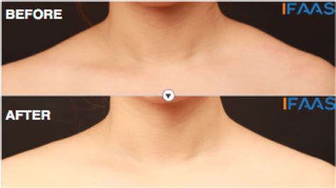 Lean And Feminine Shoulder Lines Achieved With Botulinum Toxin