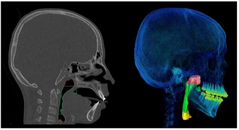 Nasopharyngeal Airway In Brain