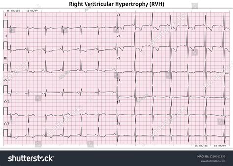 ECG Right Ventricular Hypertrophy LVH Left Royalty Free Stock