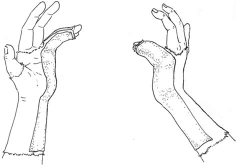 Ulnar Gutter Splint Procedure