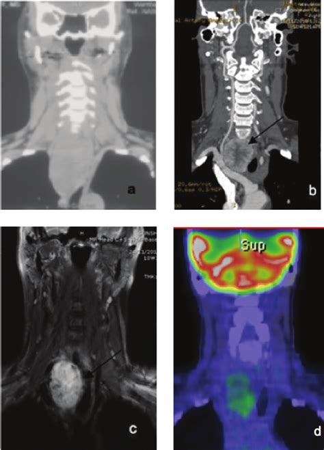 Neck Computed Tomography Ct Without Contrast A Showing Homogenous Download Scientific