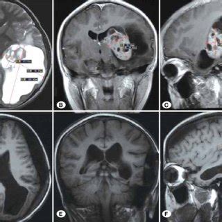 MRI showing a huge anaplastic ependymoma in a 2-year-old boy who had an ...