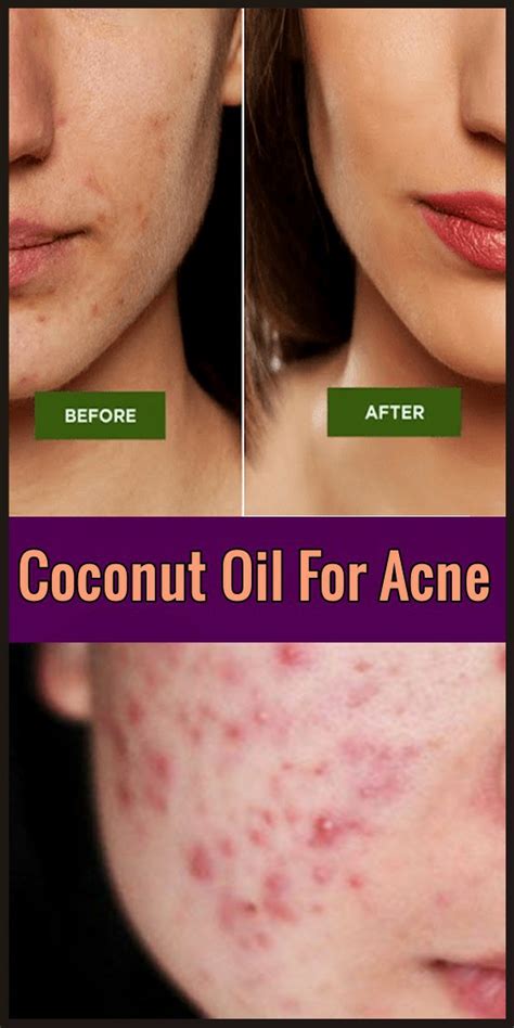 Coconut Oil For Acne