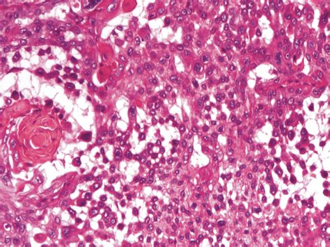 Acantholytic Squamous Cell Carcinoma With Many Acantholytic Cells He