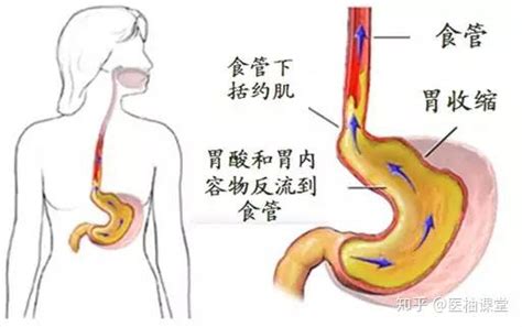 胃食管反流病怎么治，看这篇就够了！ 知乎