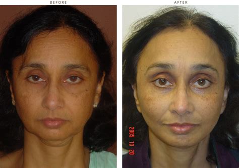 Mid Face Lift – Before and After Pictures * – Dr Turowski – Plastic ...