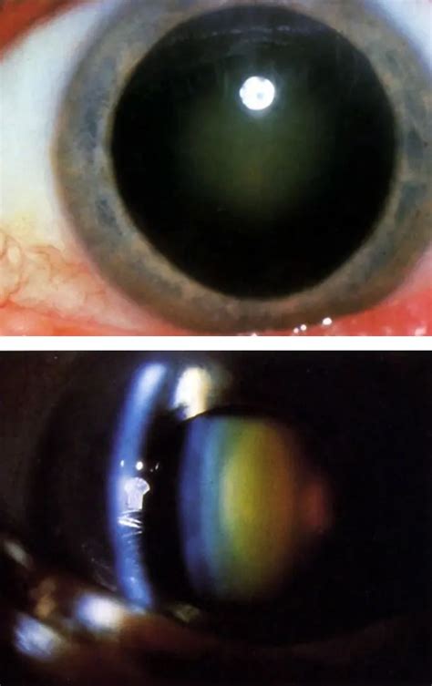 Nuclear Cataract American Academy Of Ophthalmology