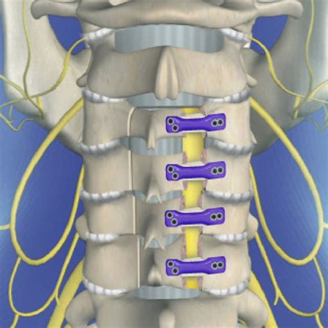 Laminectomy Or Laminoplasty Surgery In Mumbai Dr Saijyot Raut