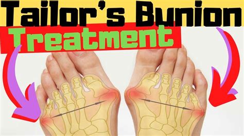 Tailor S Bunion Bunionette Pads Correctors Treatment Surgery