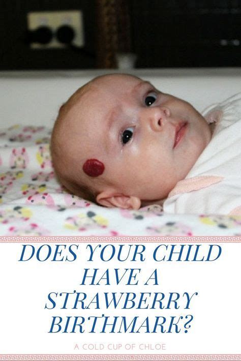 Strawberry Birthmarks Infantile Hemangioma Birthmarks Birthmark