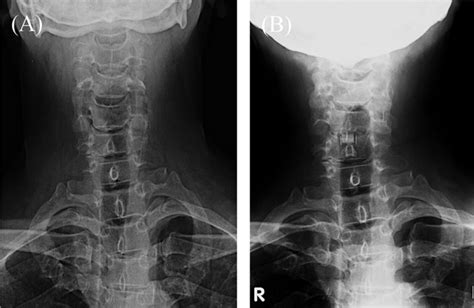 Roentgenograms Of C5 6 Anterior Fusion And Scoliosis Of The Download Scientific Diagram