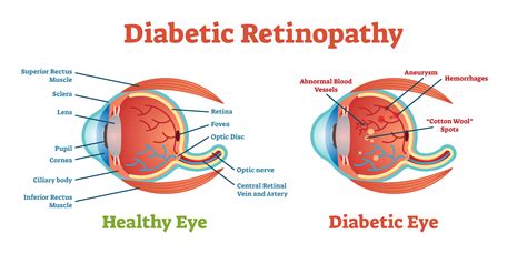 Lupus Retinopathy - Kaleidoscope Fighting Lupus