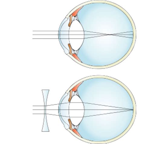 myopia management altrincham eyewear eye clinic