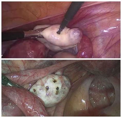 Polycystic Ovary Syndrome Pcos Symptoms And Treatment Idiseases