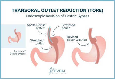 Bariatric Revision In Livingston New Jersey