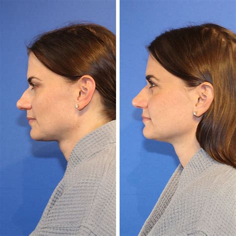 Rhinoplasty Dr Jeffrey Lisiecki