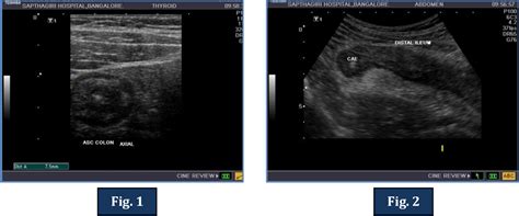 Figure From Imaging Perspective Of Primary Eosinophilic Enterocolitis