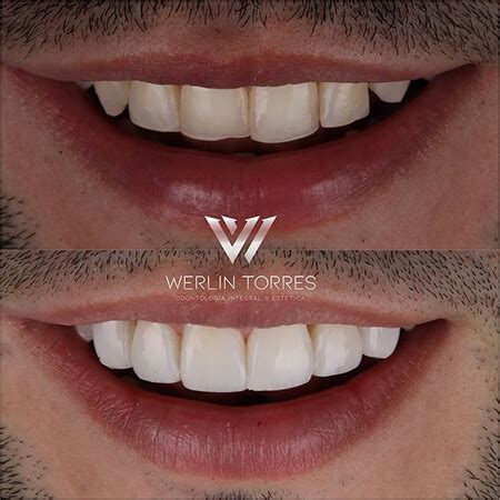 Before And After Smile Design Veneers Werlin Torres Odontolog A