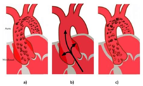 4 Effet Windkessel Dans L Aorte Thoracique Ascendante A Et B Pendant