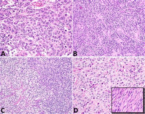 Clinicopathologic And Molecular Spectrum Of Testicular Sex Cord Stromal