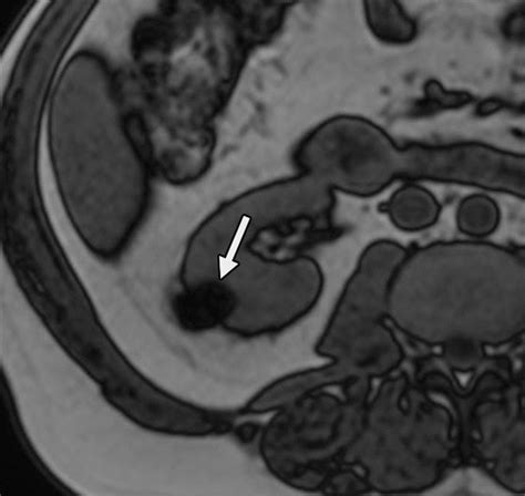 Diagnostic Approach To Benign And Malignant Calcifications In The