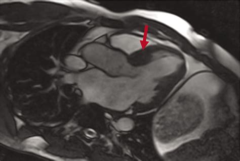 Patterns Of Left Ventricular Hypertrophy And Late Gadolinium