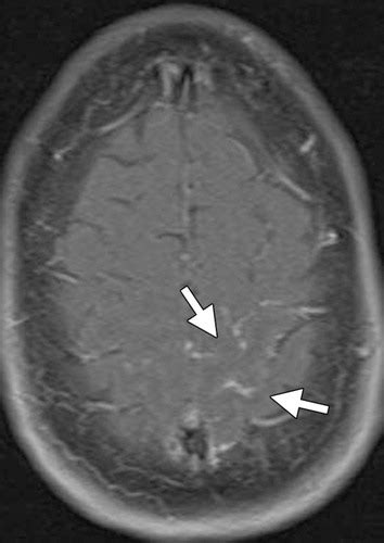 Sequence Specific Mr Imaging Findings That Are Useful In Dating Ischemic Stroke Telegraph