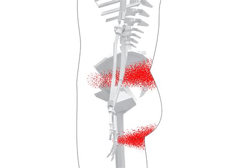 Quadratus Lumborum Trigger Point