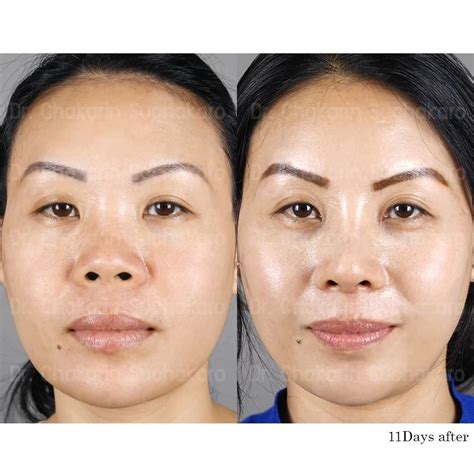 Asian Rhinoplasty Before And After Photo ร่างกาย ใบหน้า