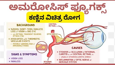 Amaurosis Fugax Cause Symptoms In Kannada