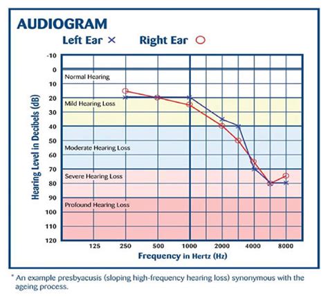 Audiograms Diagram Quizlet