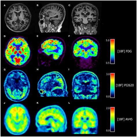 Frontiers Case Report 18F PI2620 As A Tau Imaging Agent In