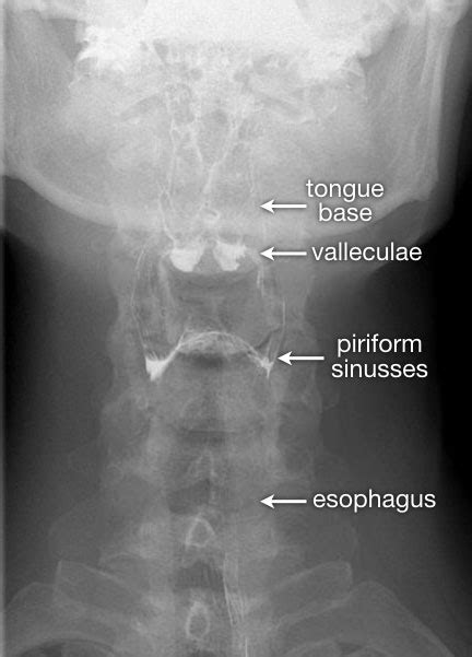 Normal Barium Swallow Anatomy