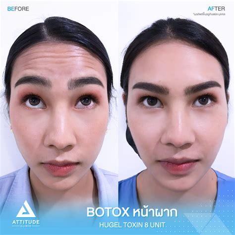 รีวิวโบท็อกซ์ Botox ลดริ้วรอยหน้าผาก และขมวดคิ้ว Attitude Clinic