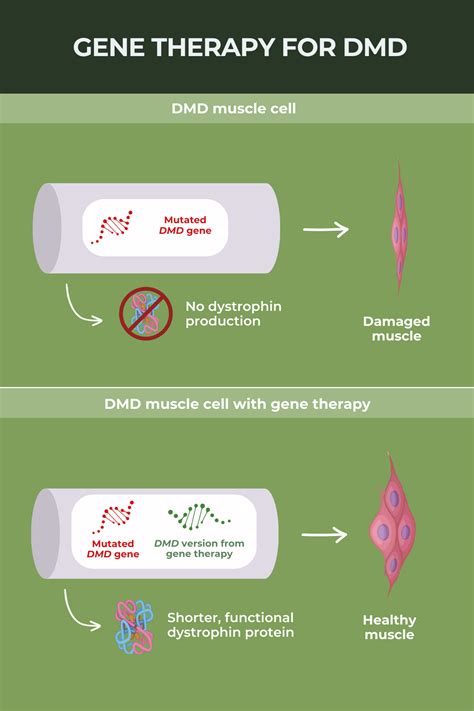 Gene therapy for Duchenne muscular dystrophy | Muscular Dystrophy News