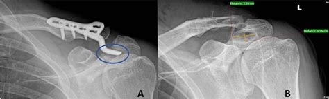 A B Plain Ap Radiograph Of Left Ac Joint With Hook Plate In Situ