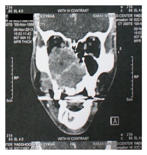 After 6 Months Preoperative A B Extraoral Frontal And Lateral