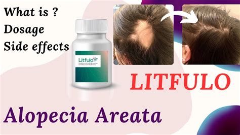 Litfulo Alopecia Treatment Overview Reviews Pfizer S Breakthrough