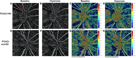 Frontiers Peripapillary Vascular Reactivity In Primary Open Angle