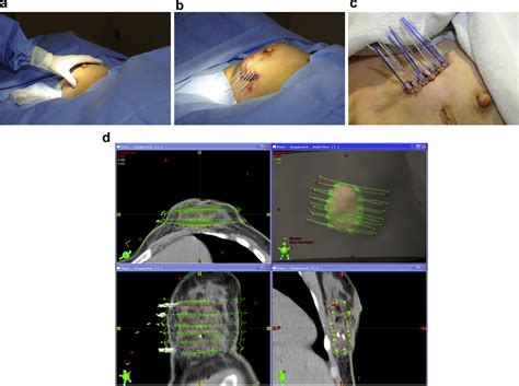 American Brachytherapy Society Consensus Report For Accelerated Partial