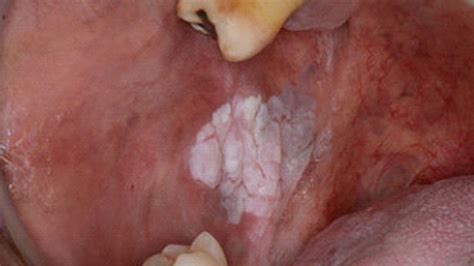 Pre Cancerous Lesions Of Oral Mucosa Dental Clinic