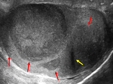 Sagittal Gray Scale Sonograph Of The Right Testis Demonstrates Four