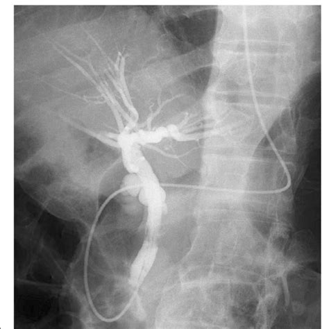 Preoperative Endoscopic Retrograde Cholangiopancreatography Image