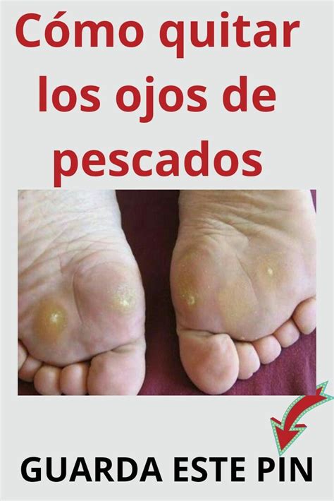 Cual Es El Ojo De Pescado En Los Pies Consejos Ojos