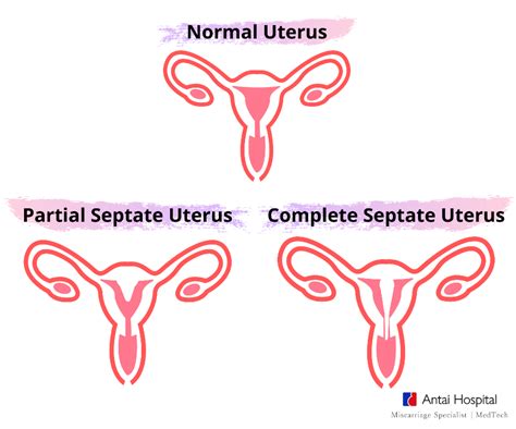 Septate Uterus May Be The Cause For Your Miscarriage Antai Hospital