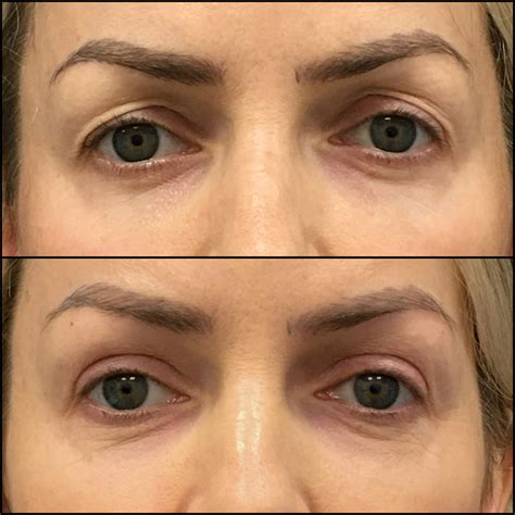 Upper Blepharoplasty Before After Photos Flora Levin Md